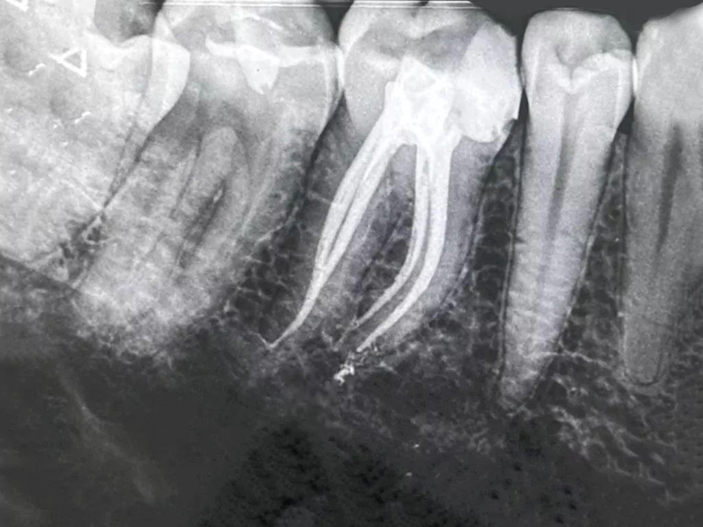 درمان ریشه X-ray